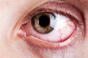 blood capillary human eye pain
